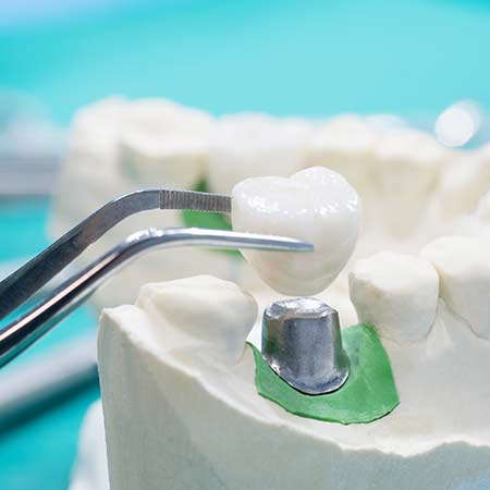 Restorative Dentistry: Dental Crowns and Bridges