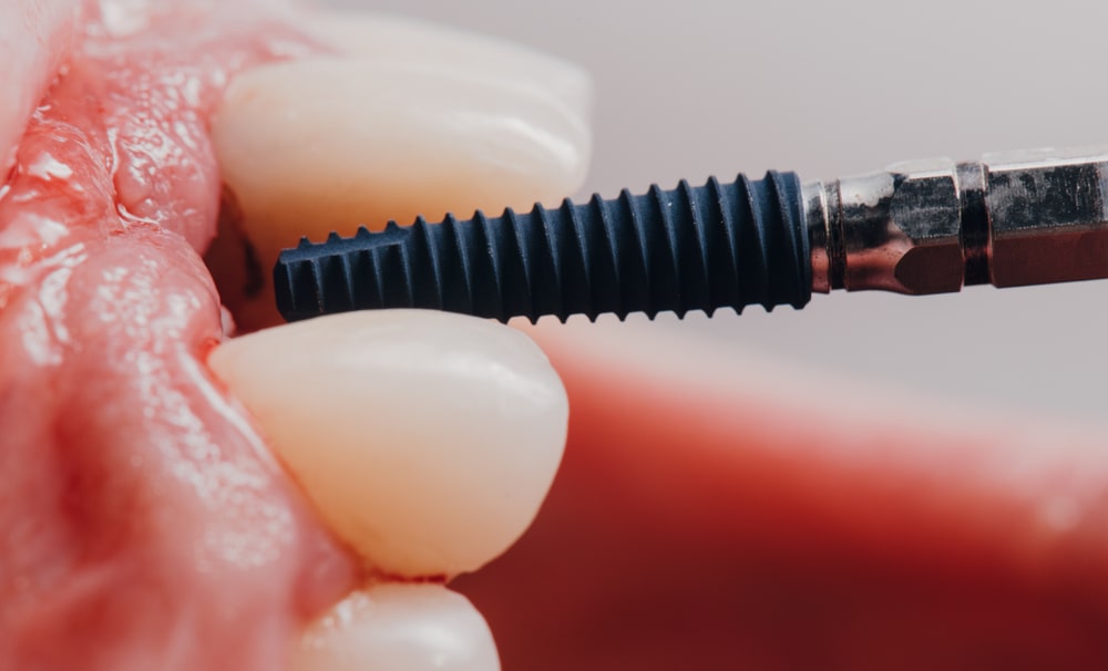 5 things-to-avoid-after-dental-implant-surgery