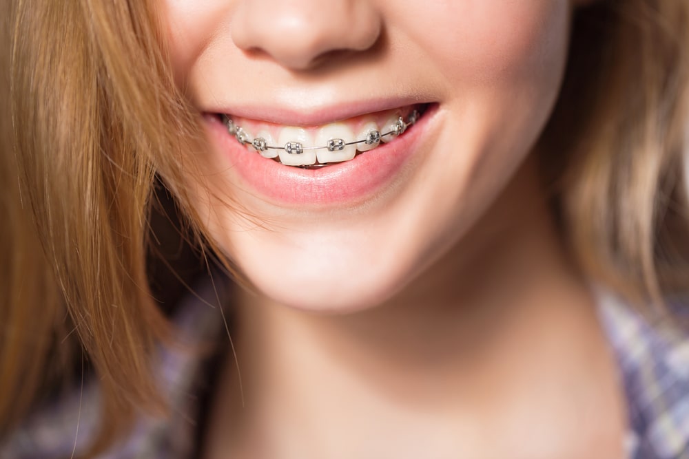 Girl with braces